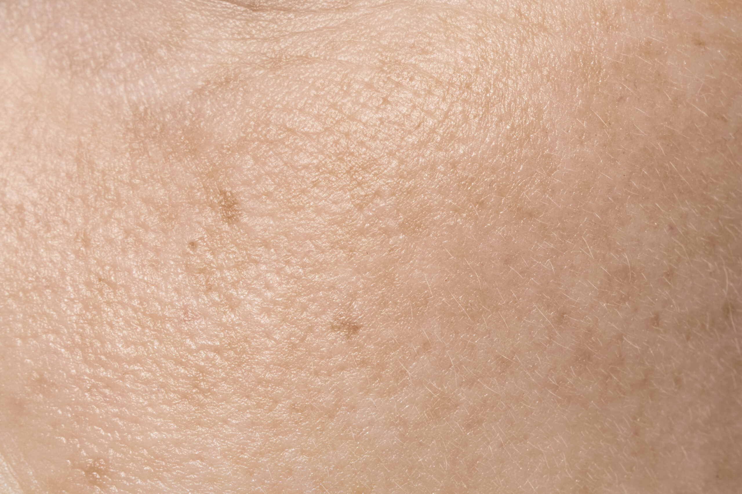 Peau sèche ou déshydratée : comment faire la différence ?